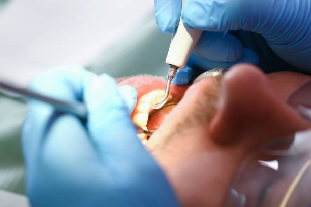 Best Emergency Wisdom Teeth Removal in Batesville, IN