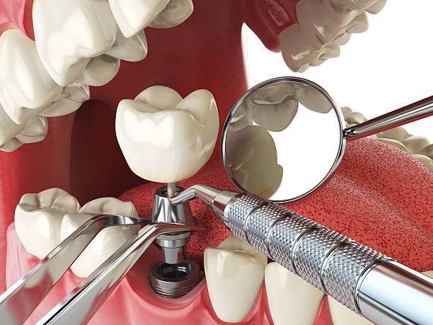 Best Emergency Treatment for Dental Infections or Abscesses in Batesville, IN